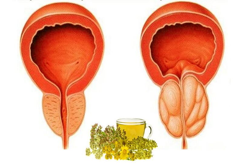 Zdrowa i obolała prostata