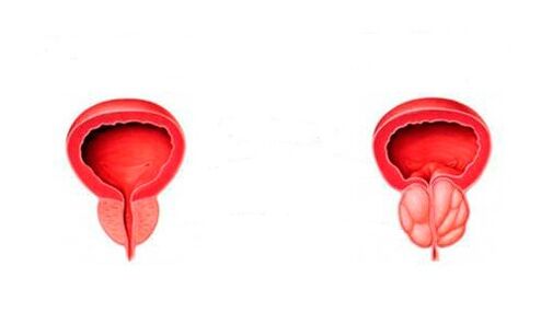 zdrowa i zapalona prostata z zapaleniem prostaty